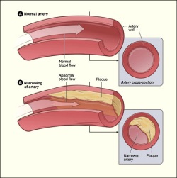 Colesterol en las arterias